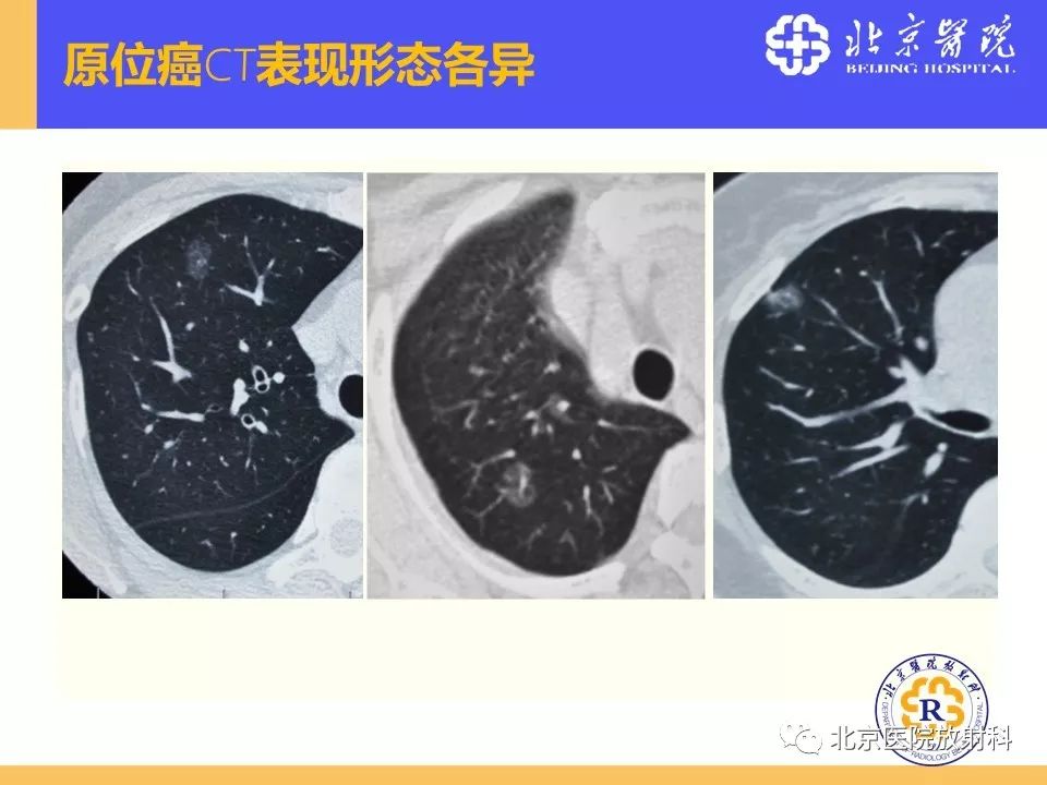 影像PPT - 【PPT】肺磨玻璃结节诊断和应对方法-39