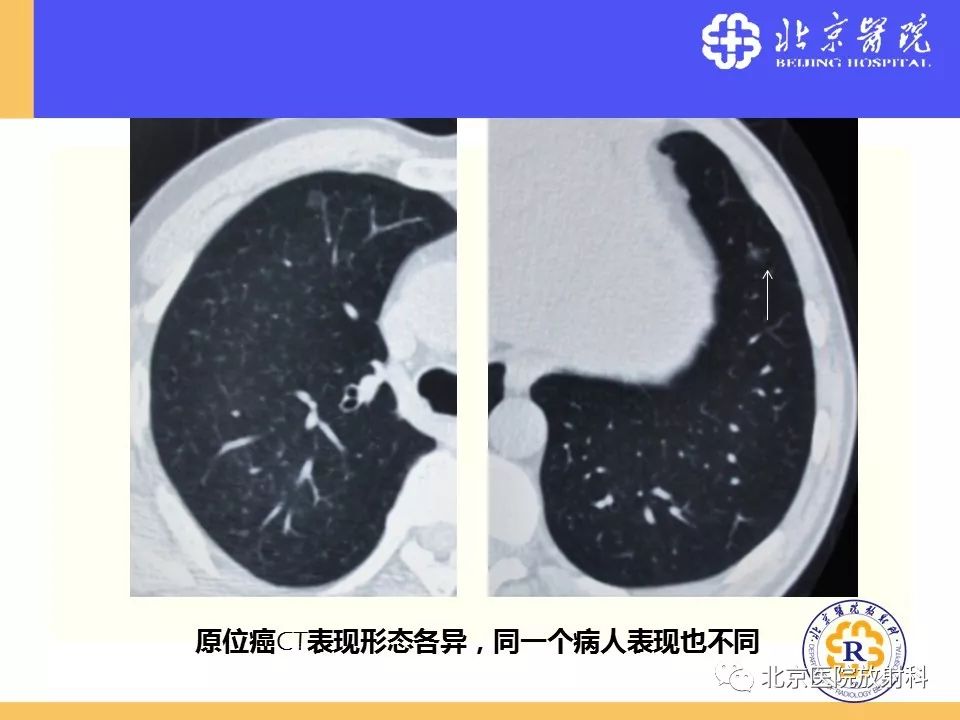 影像PPT - 【PPT】肺磨玻璃结节诊断和应对方法-40