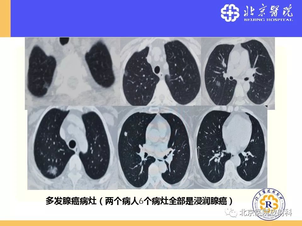 影像PPT - 【PPT】肺磨玻璃结节诊断和应对方法-41