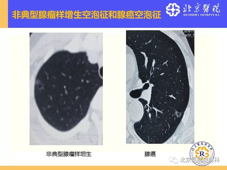 影像PPT - 【PPT】肺磨玻璃结节诊断和应对方法-43