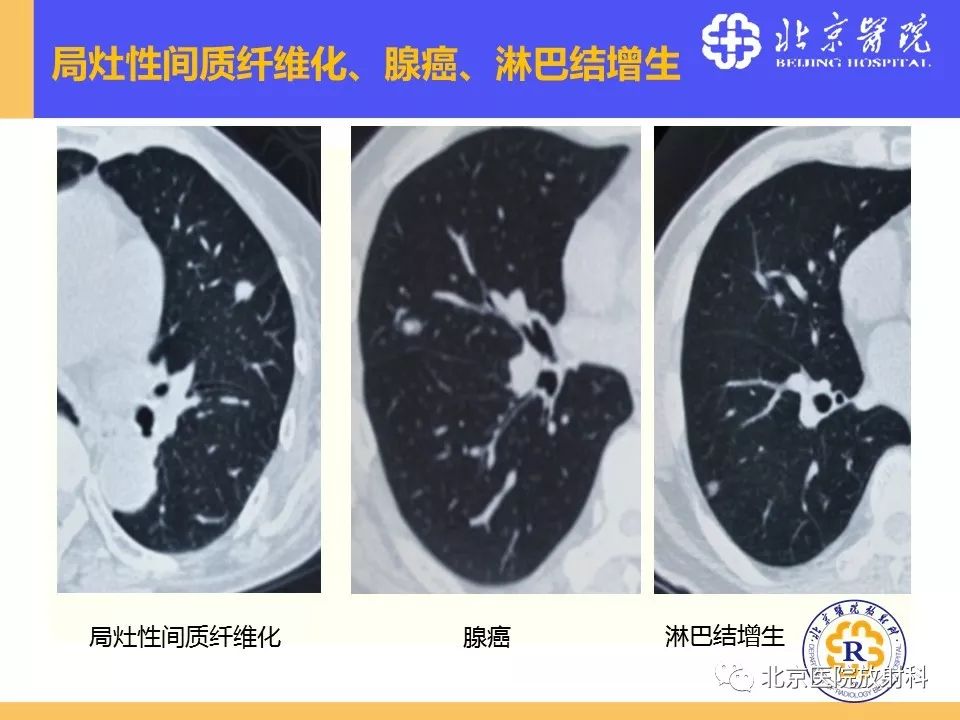 影像PPT - 【PPT】肺磨玻璃结节诊断和应对方法-44
