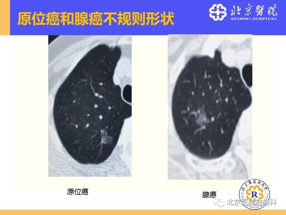 影像PPT - 【PPT】肺磨玻璃结节诊断和应对方法-45