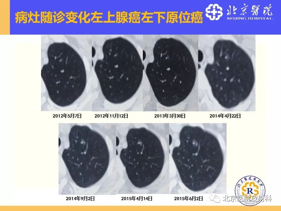 影像PPT - 【PPT】肺磨玻璃结节诊断和应对方法-49