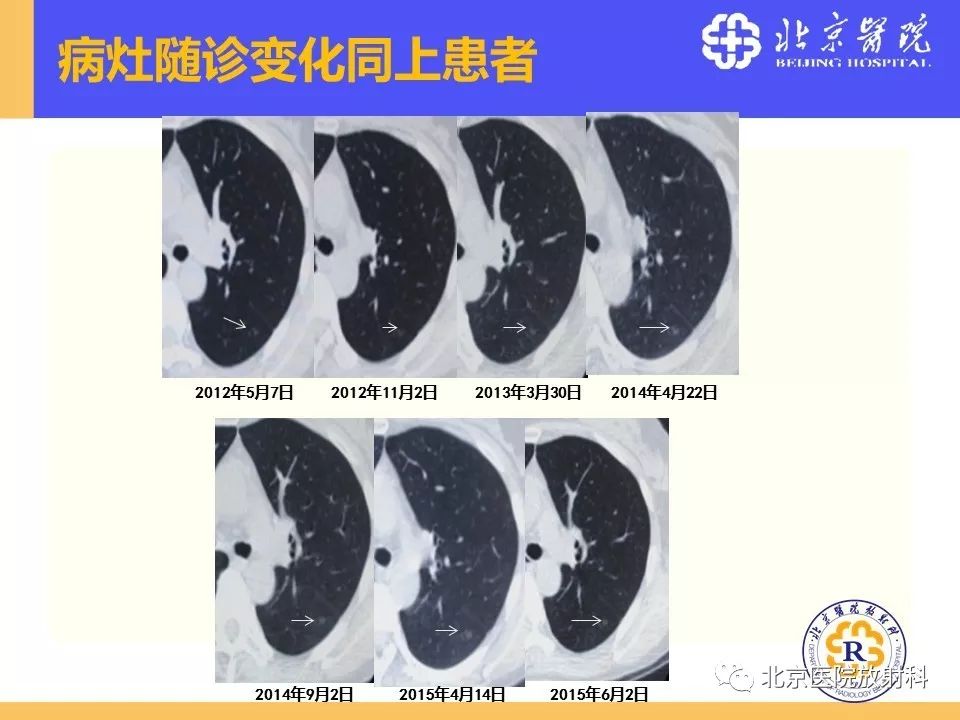 影像PPT - 【PPT】肺磨玻璃结节诊断和应对方法-50