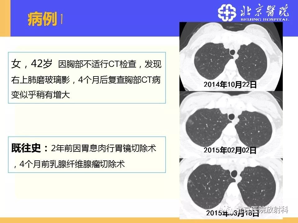 影像PPT - 【PPT】肺磨玻璃结节诊断和应对方法-55