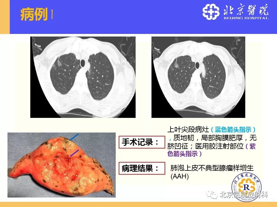 影像PPT - 【PPT】肺磨玻璃结节诊断和应对方法-56