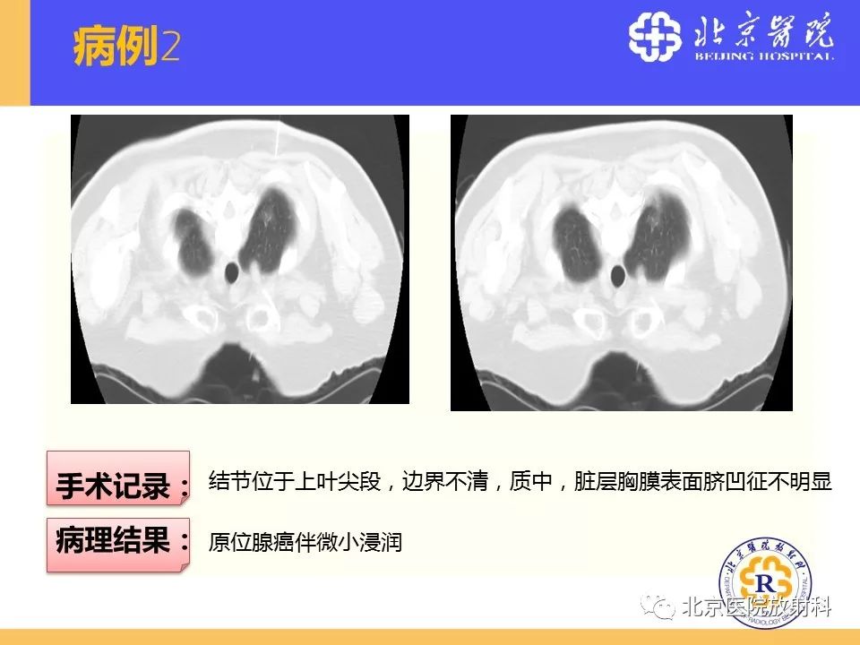 影像PPT - 【PPT】肺磨玻璃结节诊断和应对方法-58