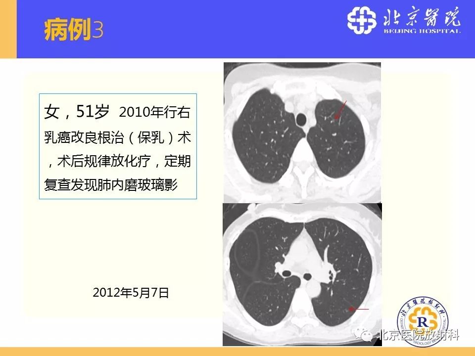 影像PPT - 【PPT】肺磨玻璃结节诊断和应对方法-59