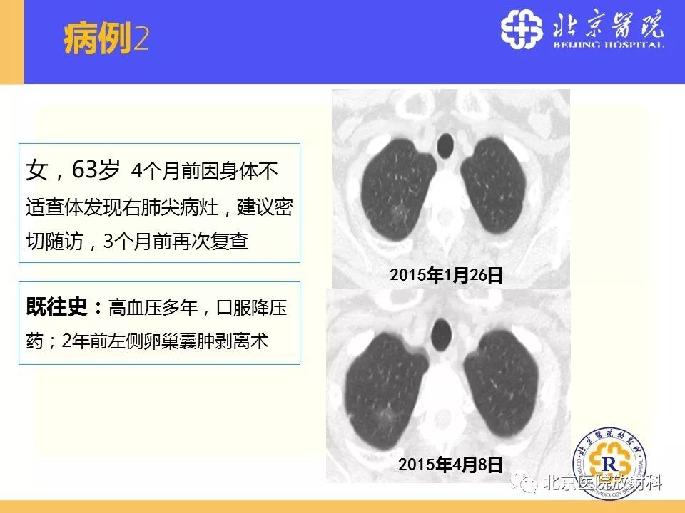 影像PPT - 【PPT】肺磨玻璃结节诊断和应对方法-57