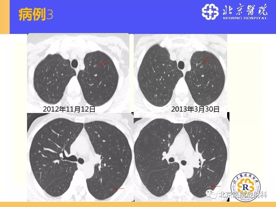 影像PPT - 【PPT】肺磨玻璃结节诊断和应对方法-60