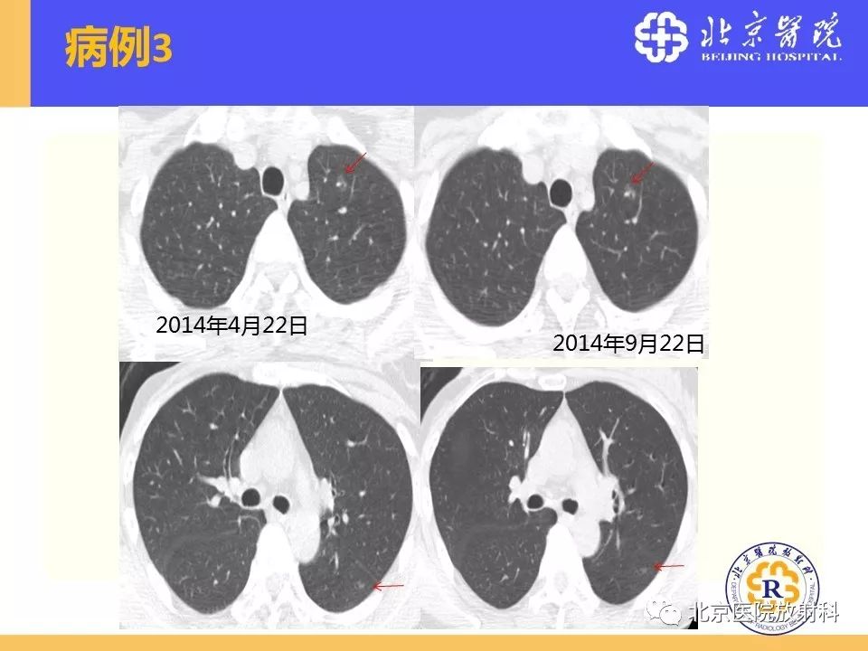 影像PPT - 【PPT】肺磨玻璃结节诊断和应对方法-61