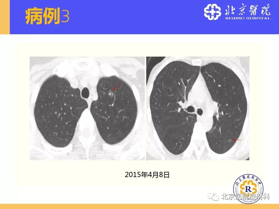 影像PPT - 【PPT】肺磨玻璃结节诊断和应对方法-62