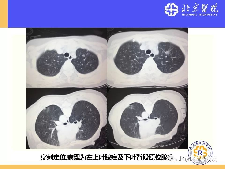 影像PPT - 【PPT】肺磨玻璃结节诊断和应对方法-63