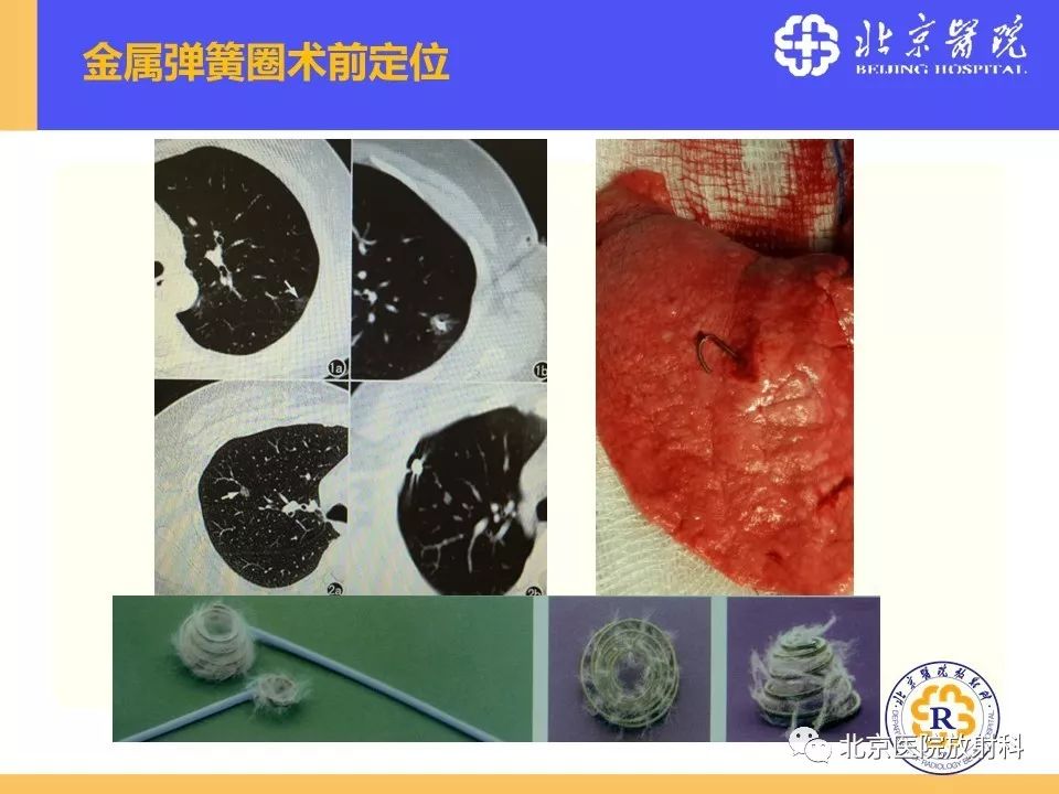 影像PPT - 【PPT】肺磨玻璃结节诊断和应对方法-65