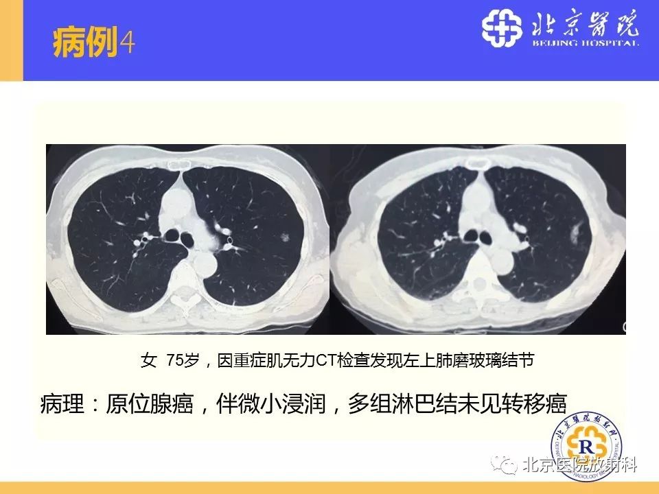 影像PPT - 【PPT】肺磨玻璃结节诊断和应对方法-64