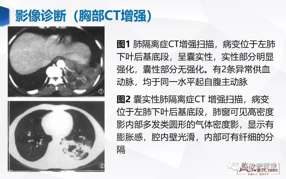 影像PPT - 【PPT】肺隔离症的影像分析-15