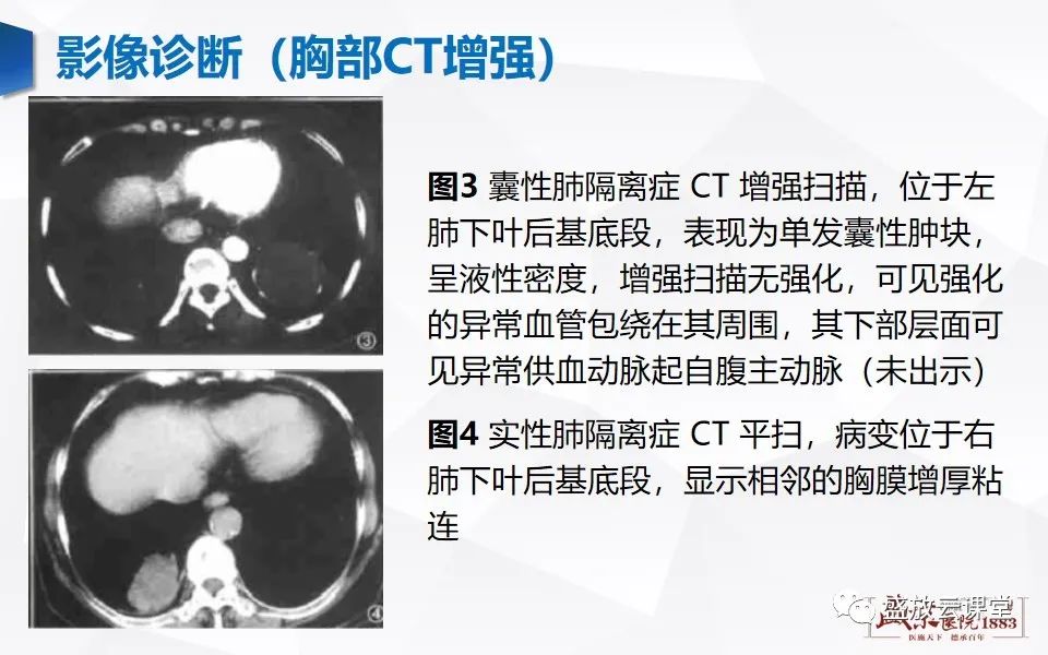 影像PPT - 【PPT】肺隔离症的影像分析-16