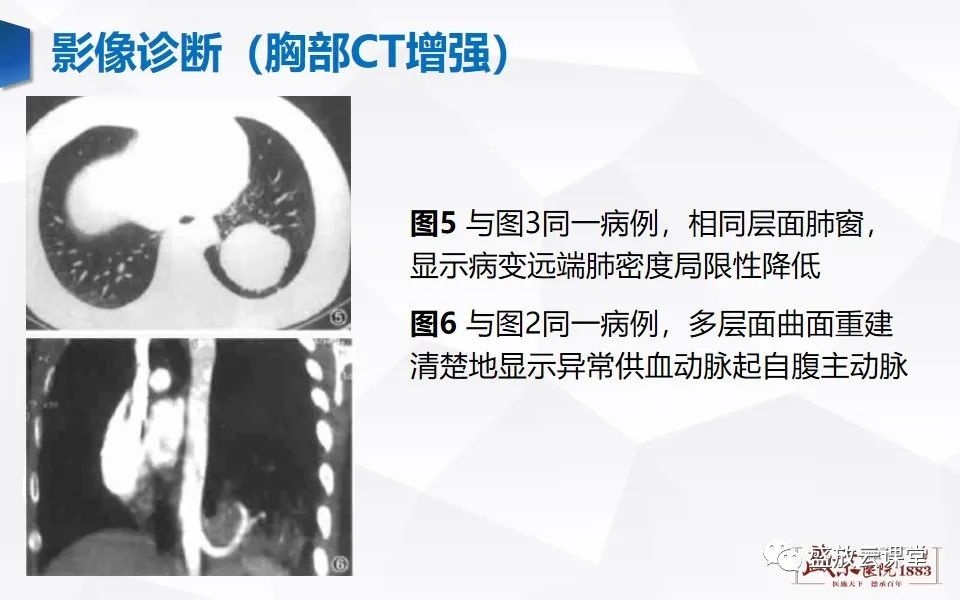 影像PPT - 【PPT】肺隔离症的影像分析-17