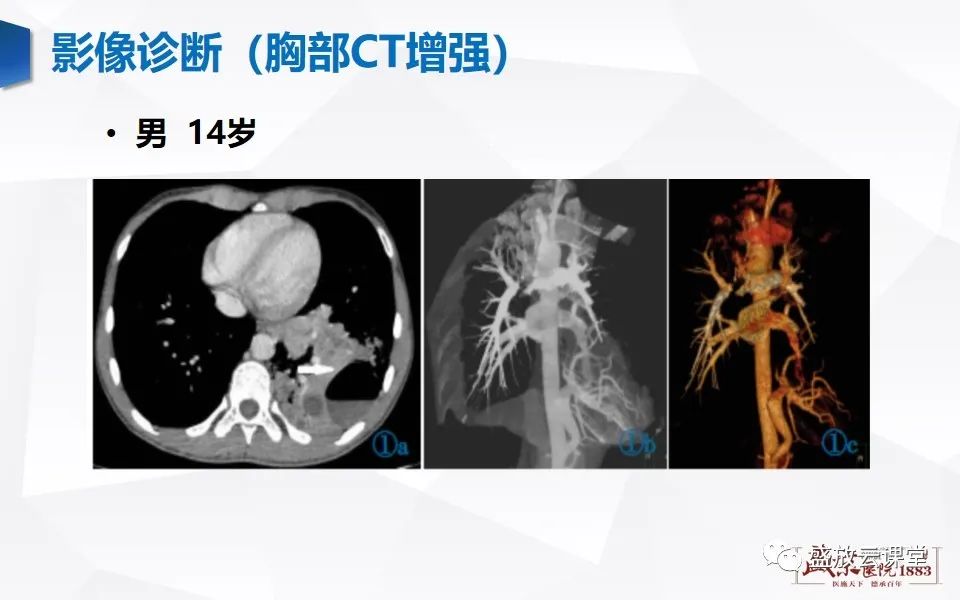 影像PPT - 【PPT】肺隔离症的影像分析-18