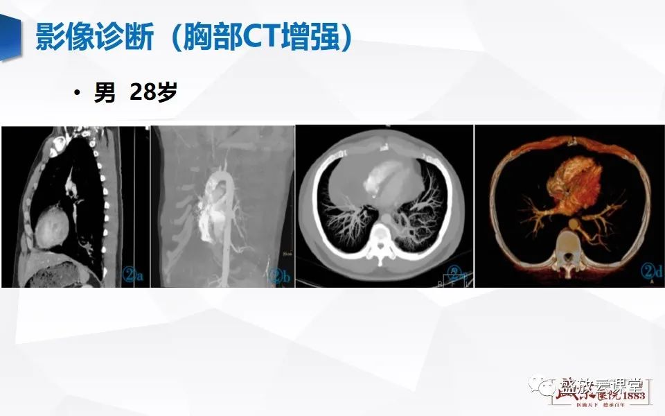 影像PPT - 【PPT】肺隔离症的影像分析-20