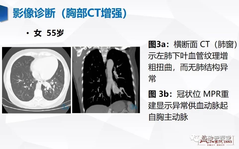 影像PPT - 【PPT】肺隔离症的影像分析-22