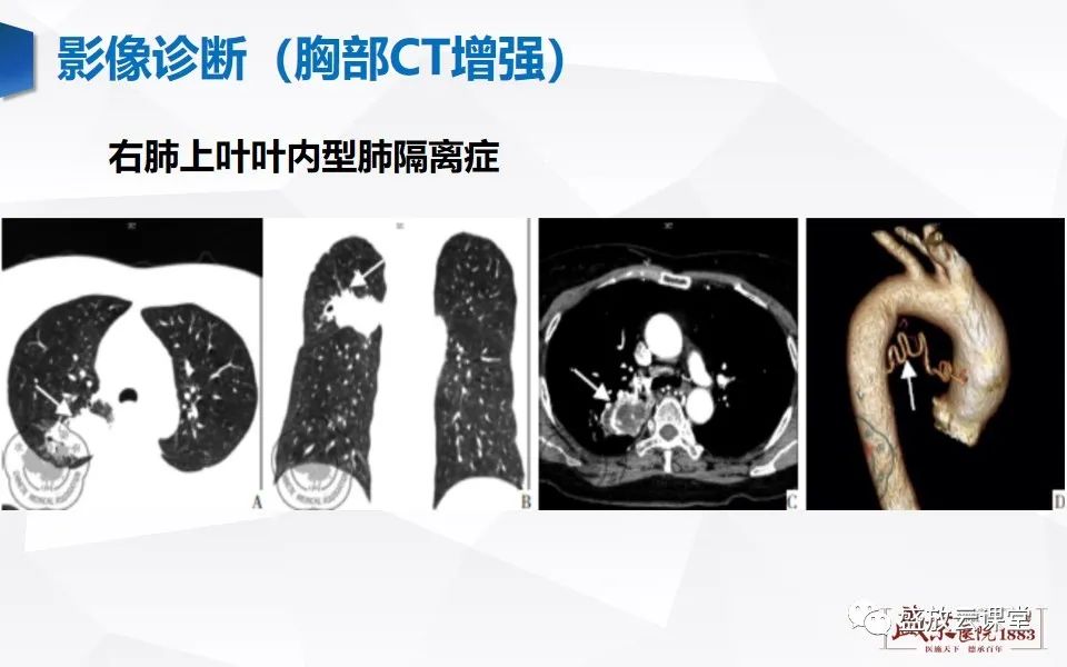 影像PPT - 【PPT】肺隔离症的影像分析-23