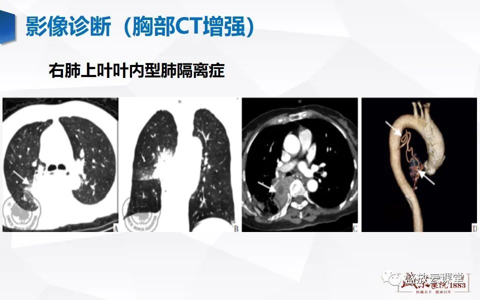 影像PPT - 【PPT】肺隔离症的影像分析-25