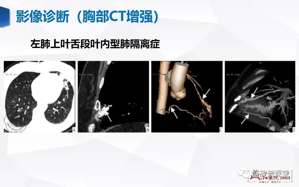 影像PPT - 【PPT】肺隔离症的影像分析-27