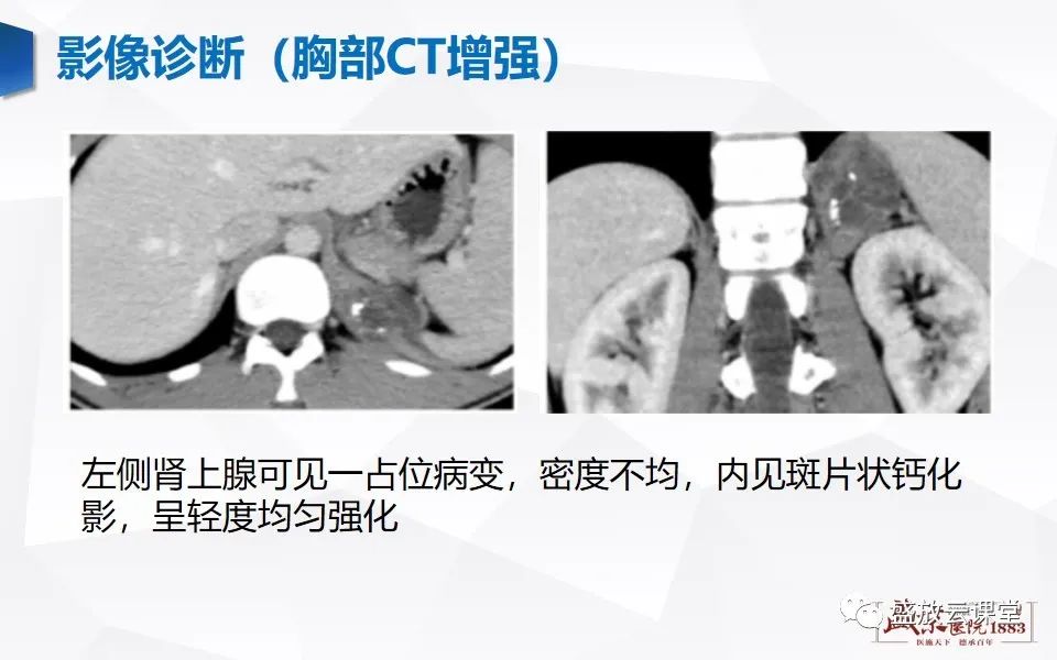 影像PPT - 【PPT】肺隔离症的影像分析-29