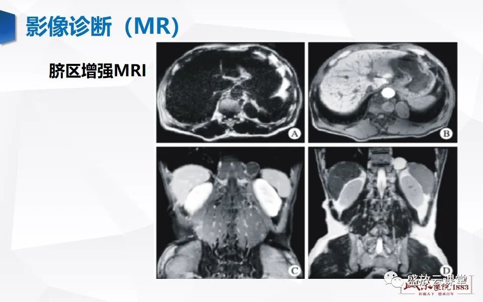 影像PPT - 【PPT】肺隔离症的影像分析-33