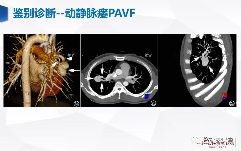 影像PPT - 【PPT】肺隔离症的影像分析-40
