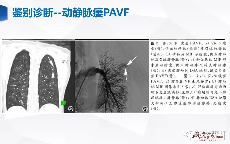 影像PPT - 【PPT】肺隔离症的影像分析-41