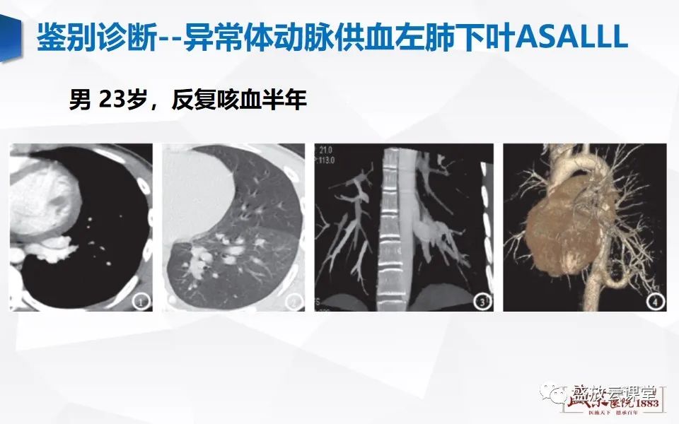 影像PPT - 【PPT】肺隔离症的影像分析-45