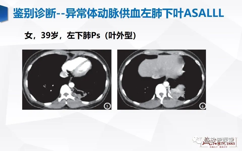 影像PPT - 【PPT】肺隔离症的影像分析-47