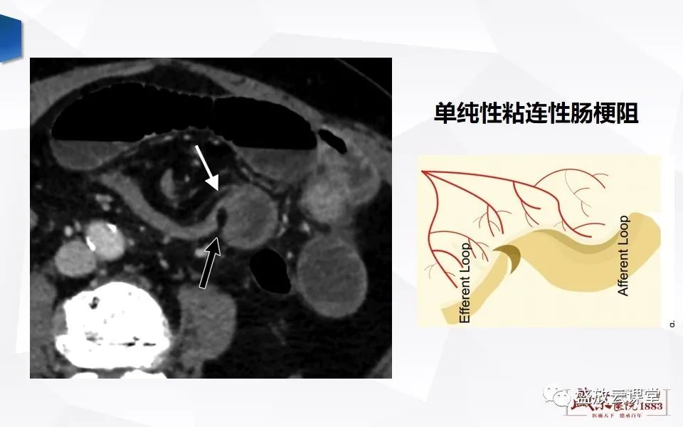 影像PPT - 【PPT】小肠梗阻的CT诊断思路-13