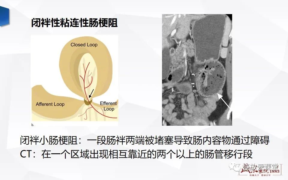 影像PPT - 【PPT】小肠梗阻的CT诊断思路-15