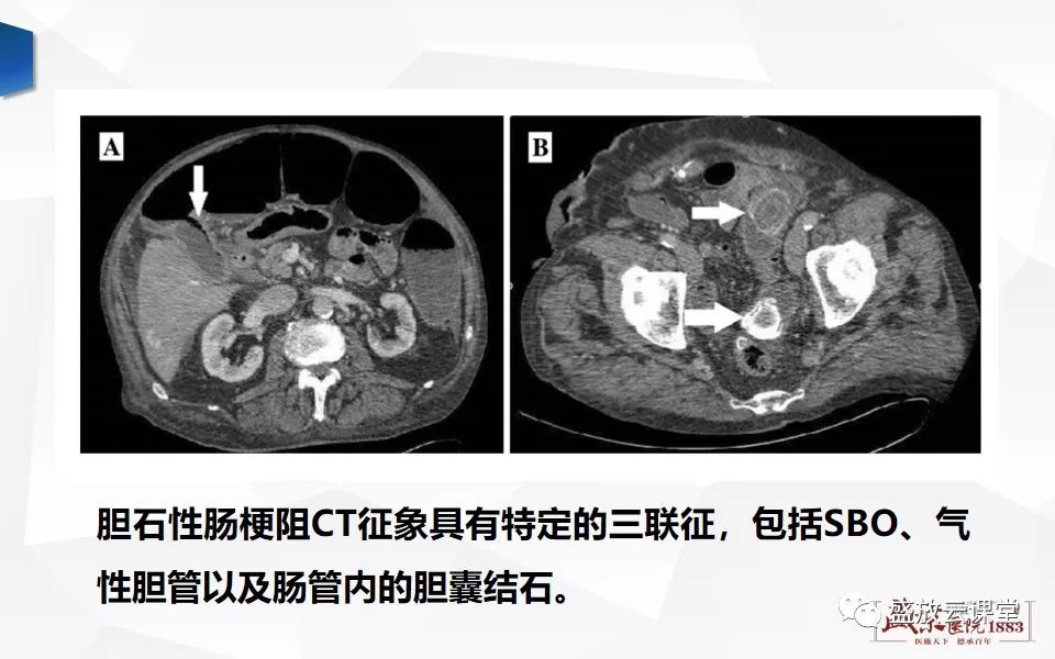 影像PPT - 【PPT】小肠梗阻的CT诊断思路-19
