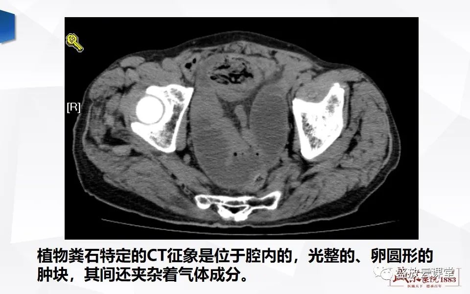 影像PPT - 【PPT】小肠梗阻的CT诊断思路-20