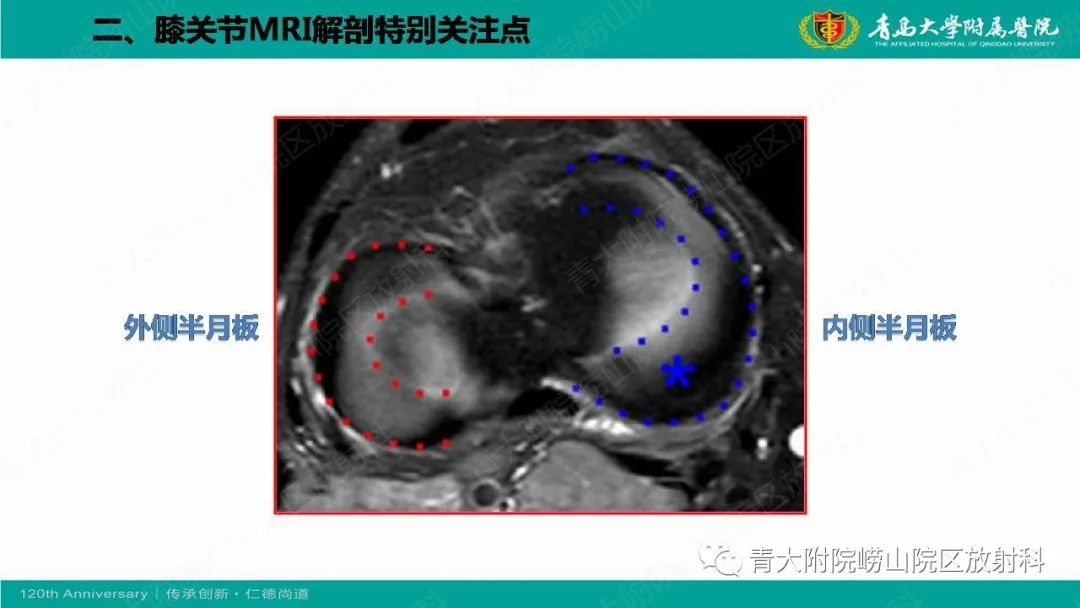 影像PPT - 【PPT】膝关节半月板及常见韧带损伤的磁共振诊断-5