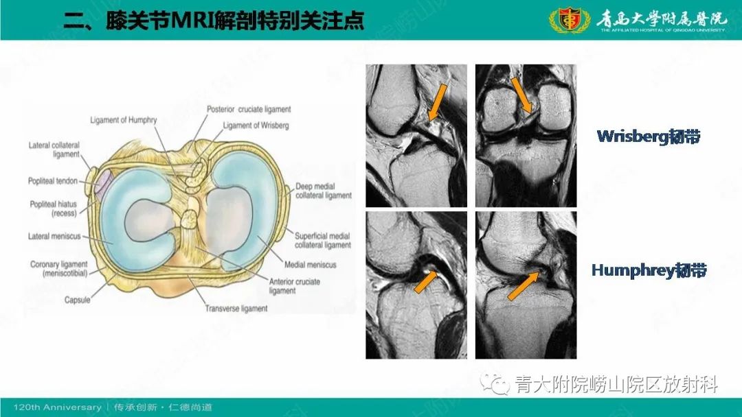影像PPT - 【PPT】膝关节半月板及常见韧带损伤的磁共振诊断-8