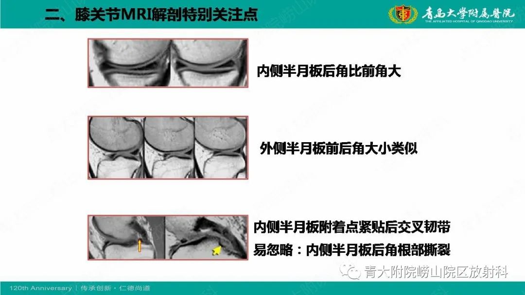 影像PPT - 【PPT】膝关节半月板及常见韧带损伤的磁共振诊断-6