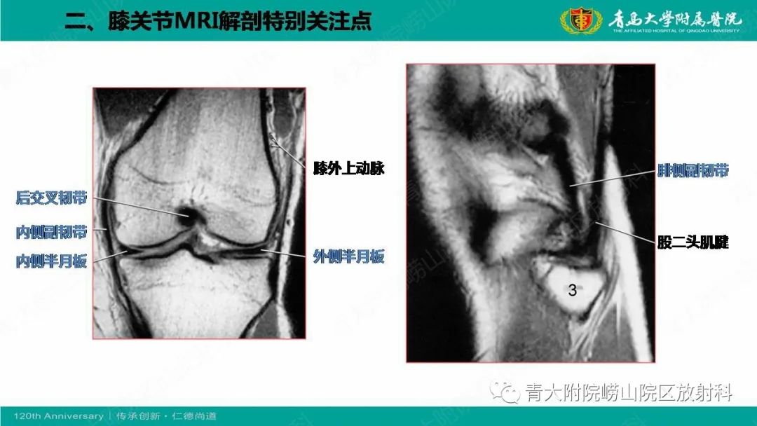 影像PPT - 【PPT】膝关节半月板及常见韧带损伤的磁共振诊断-10