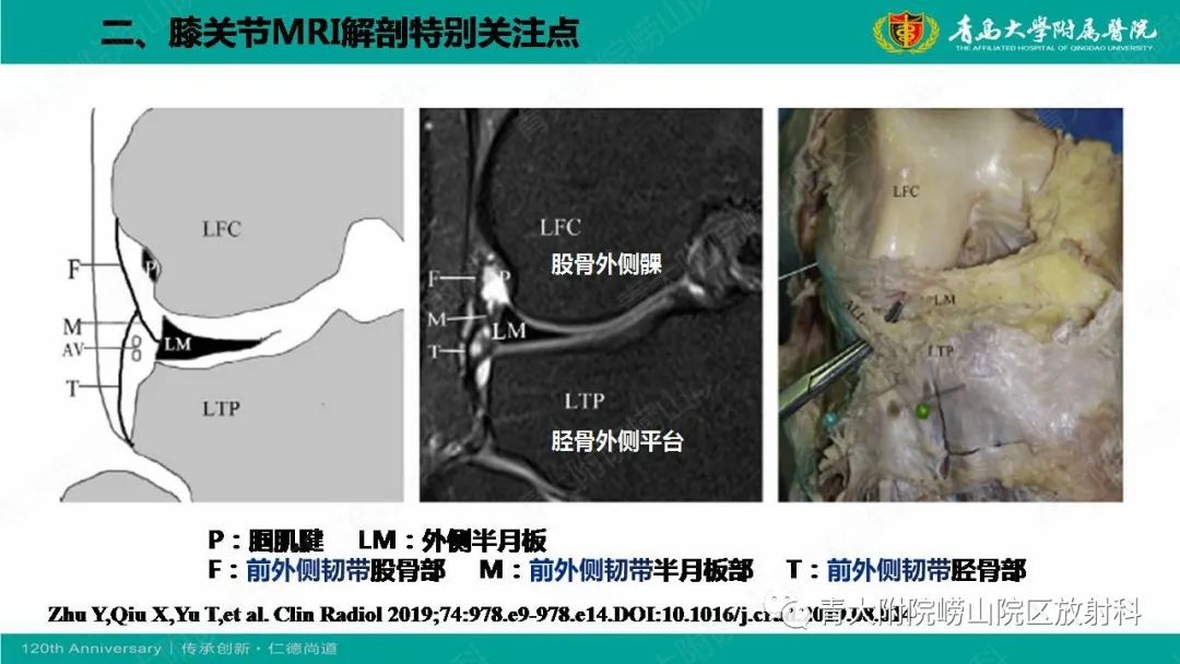 影像PPT - 【PPT】膝关节半月板及常见韧带损伤的磁共振诊断-11
