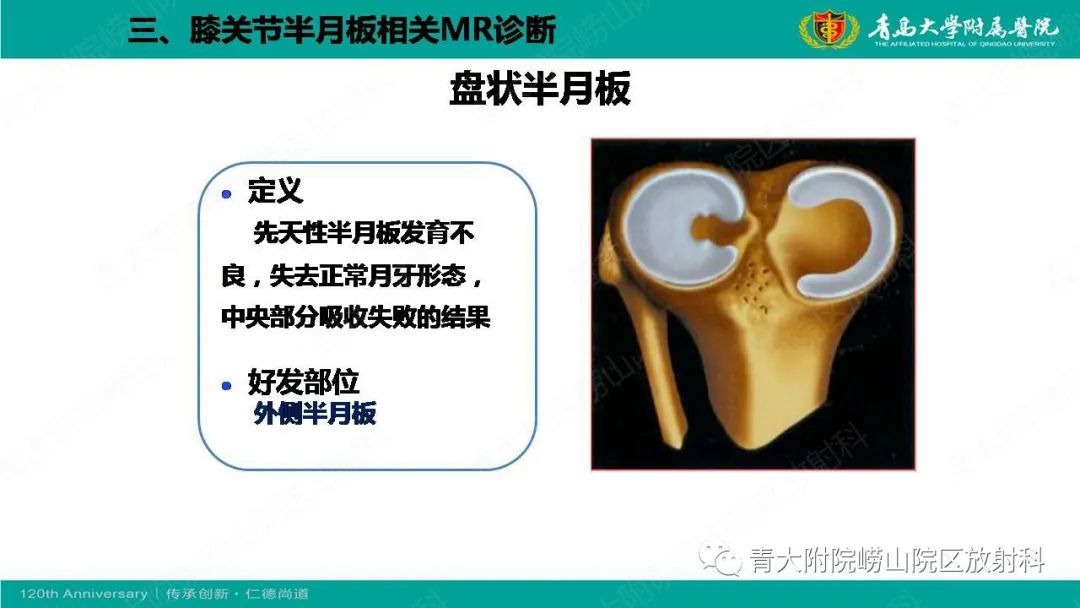 影像PPT - 【PPT】膝关节半月板及常见韧带损伤的磁共振诊断-13