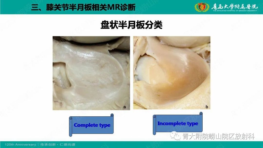 影像PPT - 【PPT】膝关节半月板及常见韧带损伤的磁共振诊断-14