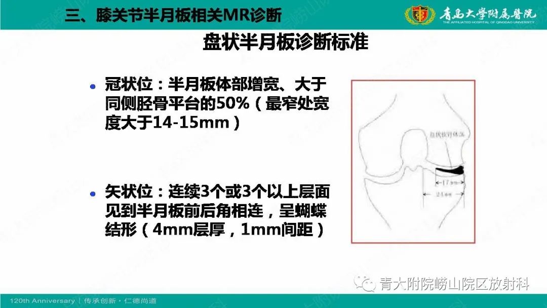 影像PPT - 【PPT】膝关节半月板及常见韧带损伤的磁共振诊断-15