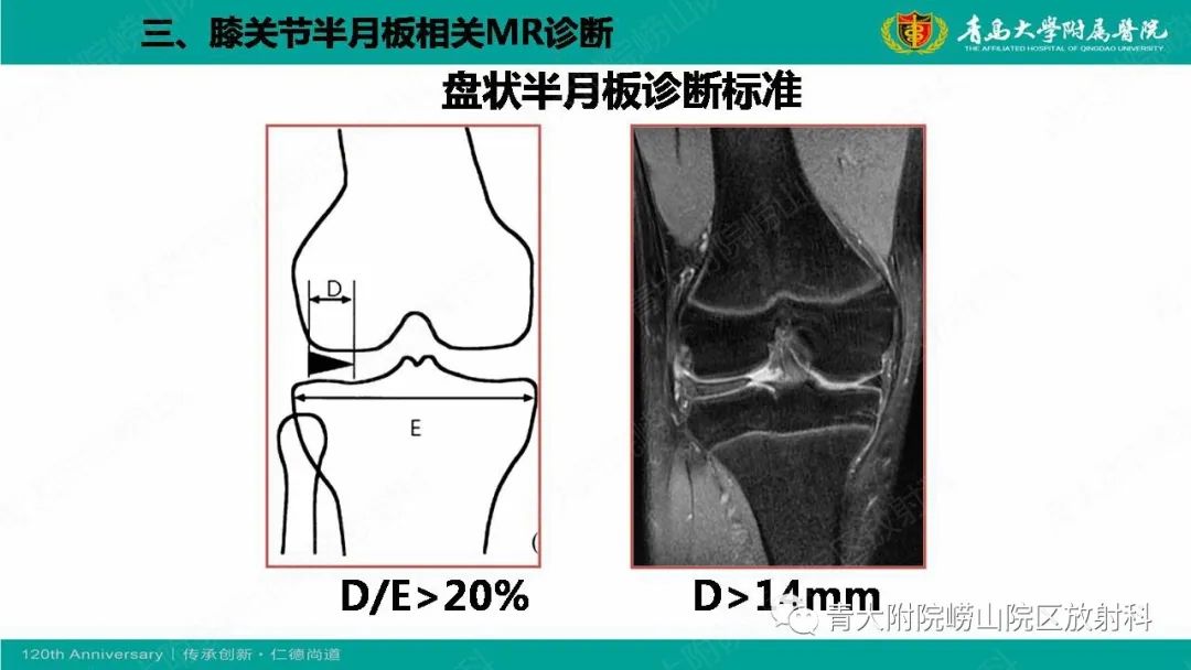 影像PPT - 【PPT】膝关节半月板及常见韧带损伤的磁共振诊断-16