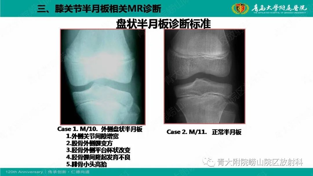 影像PPT - 【PPT】膝关节半月板及常见韧带损伤的磁共振诊断-17