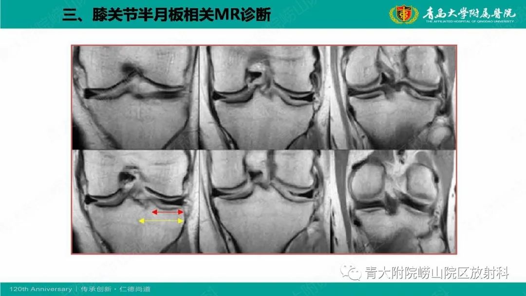 影像PPT - 【PPT】膝关节半月板及常见韧带损伤的磁共振诊断-18