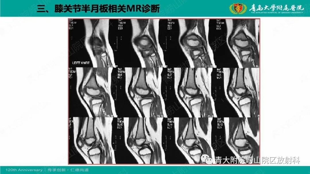 影像PPT - 【PPT】膝关节半月板及常见韧带损伤的磁共振诊断-19